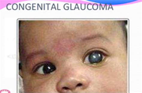 Childhood Glaucoma Congenital Glaucoma
