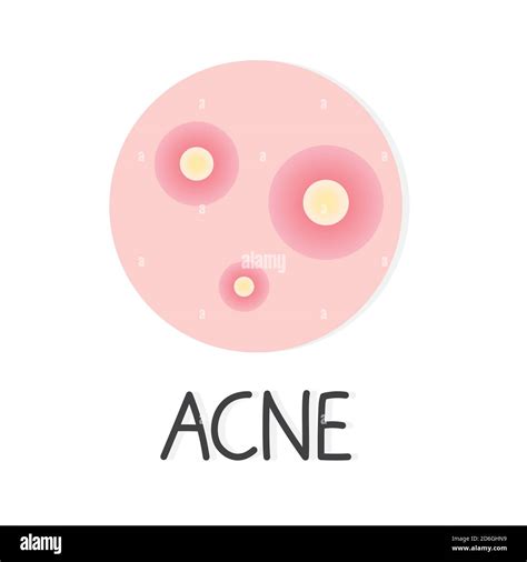 Acne Vector Vectors High Resolution Stock Photography And Images Alamy