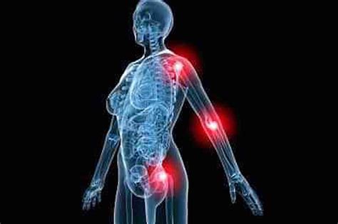 Bone Joint Pain In MPN Patients Explained Proliferative PV Reporter