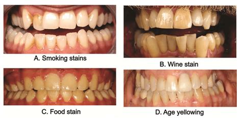 Remove Coffee Stains From Behind Teeth : The Science Behind Teeth ...