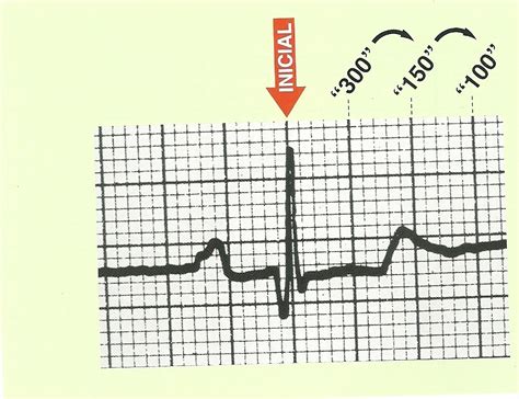 Aprende A Calcular La Frecuencia Cardíaca De 3 Formas Diferentes En El Ecg Video Medicina