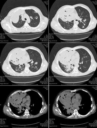 Nocardiosis - Infectious Dis. - Medbullets Step 2/3