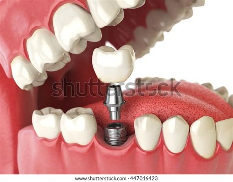 32,987 Implant Crown Images, Stock Photos & Vectors | Shutterstock