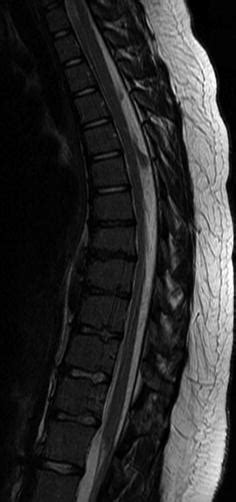 The Spine Congenital And Developmental Conditions Radiology Key