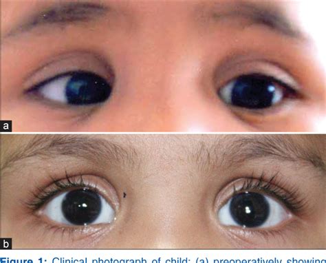 Figure 1 From Management Of Idiopathic Intracranial Hypertension In An