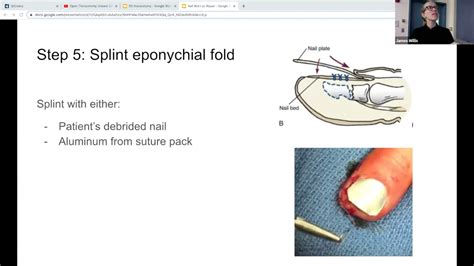 Finger Laceration Repair