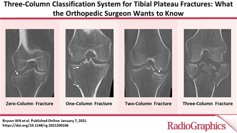 Three Column Classification System For Tibial Plateau Fractures What