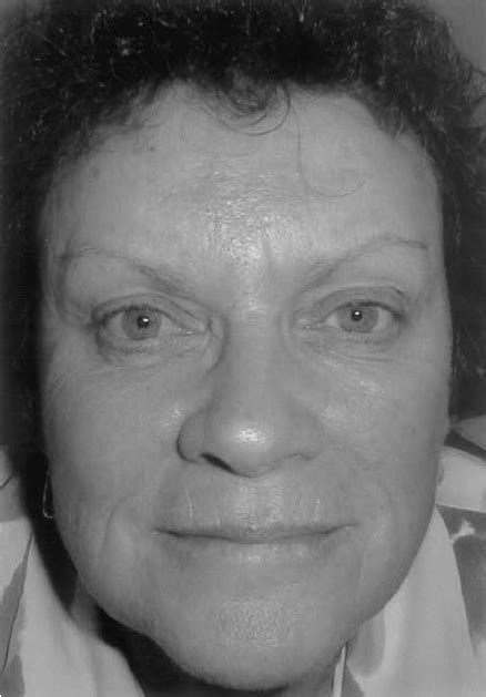 Bilateral Dermatochalasis Following Botulinum Injection To The