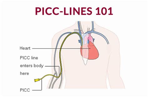 Picc Line Diagram Marica Capriotti