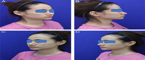 Nasal Tip And Alar Groove Plasty Through External Nasal Cutt