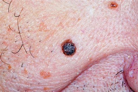 Seborrheic Keratosis Photograph By Dr P Marazzi Science Photo Library