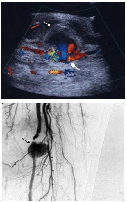 Images from case 3: Arterial pseudoaneurysm. Ultrasound image reveals a ...