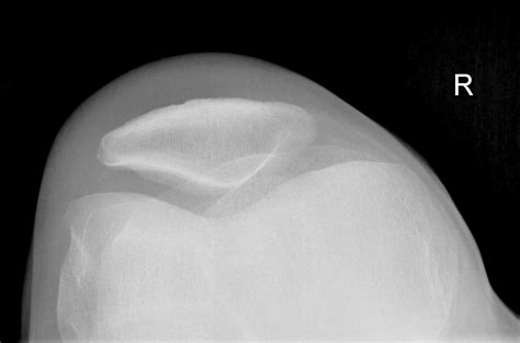 Prepatellar Bursitis Image