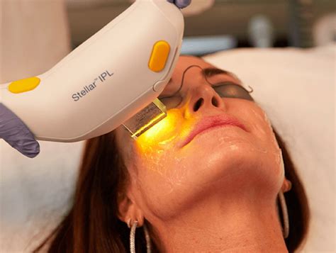 IPL Photofacial STELLAR M22 Modern Skin Clinic Of Charlotte