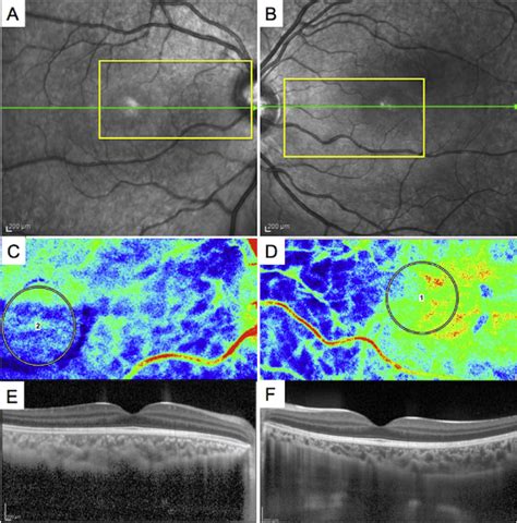 Infrared Reflectance Fundus Images Laser Speckle Flowgraphy Findings