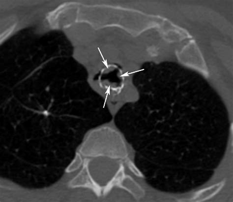 2 Multidetector Computed Tomography Imaging Of The Central Airways