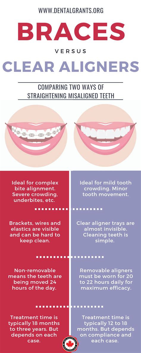 Braces vs. Clear Aligners | Clear aligners, Dental facts, Orthodontics