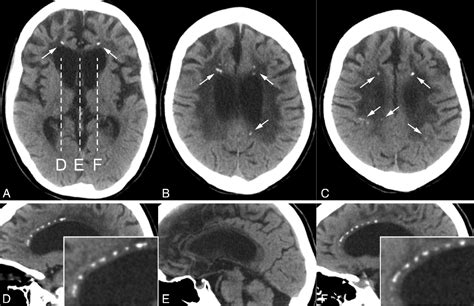 Figure 1 From Adult Onset Leukoencephalopathy With Axonal Spheroids And