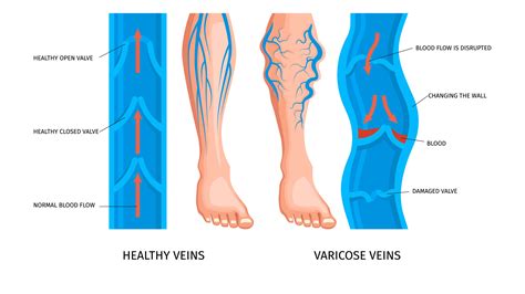 When To Worry About Varicose Veins Identifying Complications