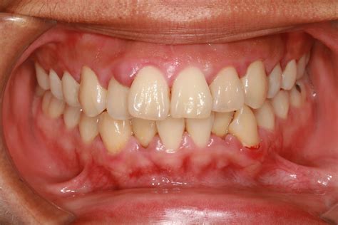 Gingivitis Symptome Ursachen Und Behandlung