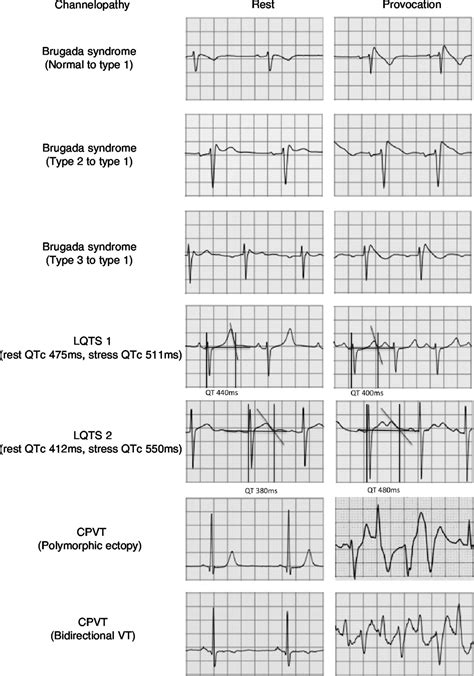 How To Perform And Interpret Provocative Testing For The Diagnosis Of