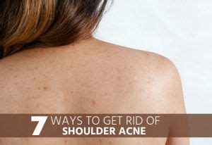 How To Get Rid Of Shoulder Acne Overnight Shoulder Acne Back Acne