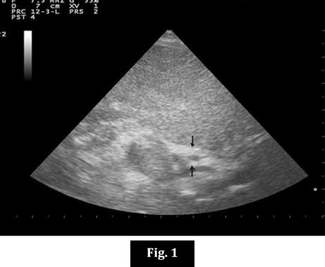 Table 2 From Sonographic Triangular Cord Sign In Biliary Atresia