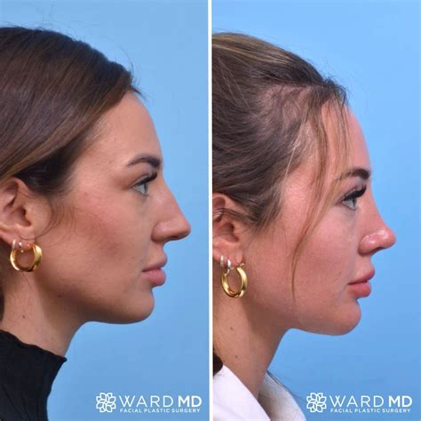 Rhinoplasty Side Profile Before After Rhinoplasty Nose Job Facial