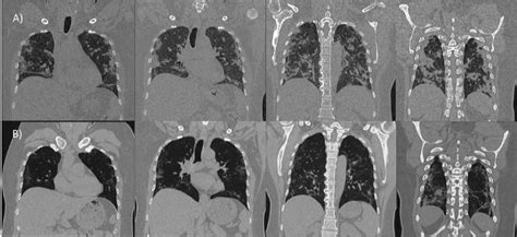 Stem Cell Nebulization Therapy For Covid Infection Radiological And