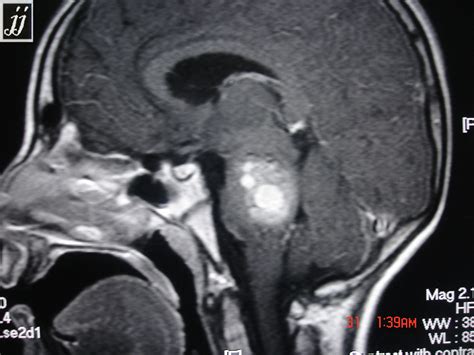 Basilar Artery Thrombosis Radiopaedia