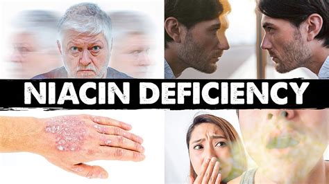 Strange & Weird Niacin (B3) Deficiency Signs And Symptoms