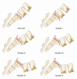 Explaining Spinal Disorders: Isthmic Spondylolisthesis