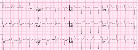 LV Aneurysm ECG | ALiEM