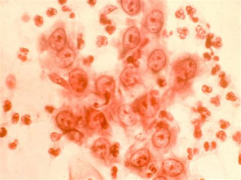 Cytopathology For General Pathology Boards Flashcards Quizlet