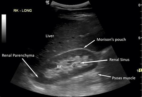 Role Of Point Of Care Ultrasound Pocus In Grading Of Hydronephrosis A Simple Approach