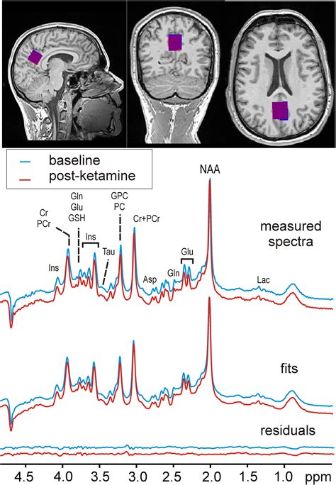 Frontiers Effect Of Ketamine On Human Neurochemistry In Posterior