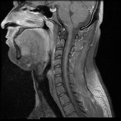 Infected Second Branchial Cleft Cyst Image