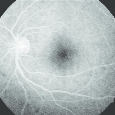 Fluorangiografía retiniana que demuestra edema de papila ojo izquierdo