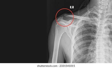 Xray Shoulder Showing Dislocation Acromioclavicular Joint Stock Photo