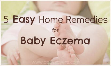 Baby Eczema Home Remedies