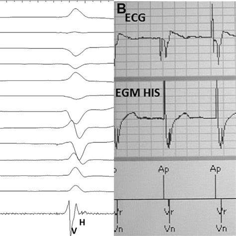 A Atrial Fibrillation With Ventricular Rhythm Paced From The Right