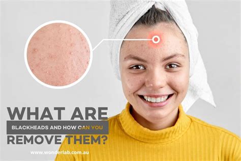 What Are Blackheads And How Can You Remove Them Wonderlab Skin