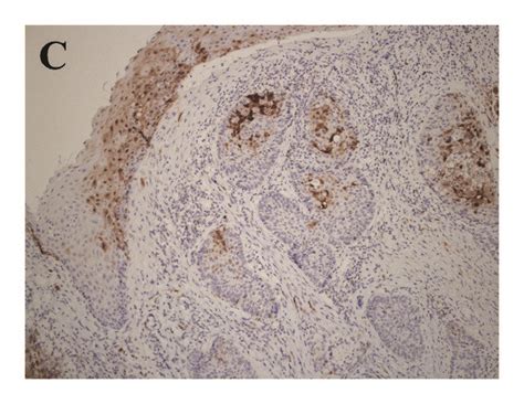 Expression Of P16 Positive Cells In Oropharyngeal Cancer Download Scientific Diagram