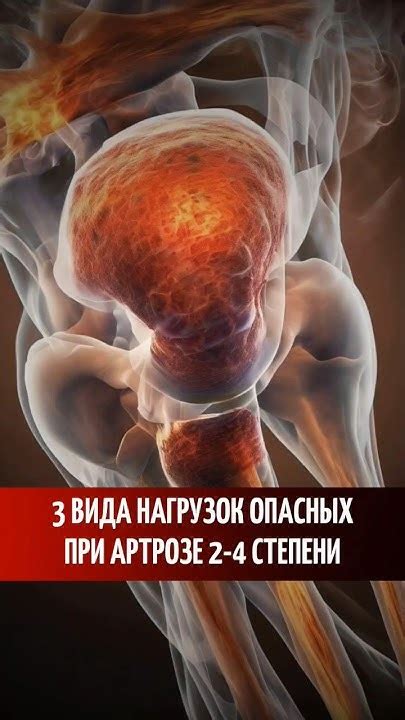 3 вида нагрузок опасных при артрозе 2-4 степени #артроз #гонартроз # ...