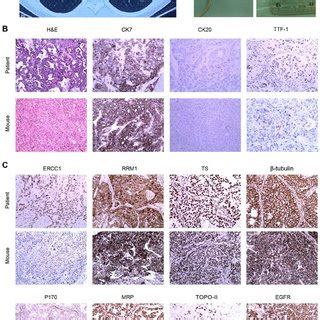 Xenograft Assay And IHC Staining A Patient With A Tumor In The Left