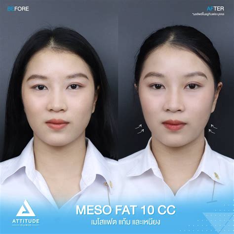 รีวิว Attitude Clinic ห้วยขวาง รีวิวปรับรูปหน้า รีวิวฉีด Meso Fat