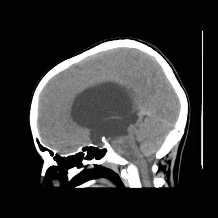 Tectal plate glioma | Radiology Case | Radiopaedia.org