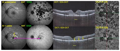 Diagnostics Free Full Text Optical Coherence Tomography Angiography