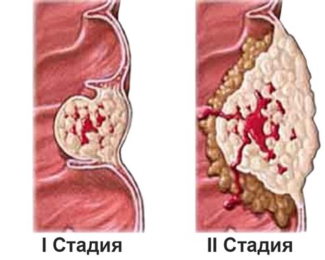 Стадии рак щитовидной железы