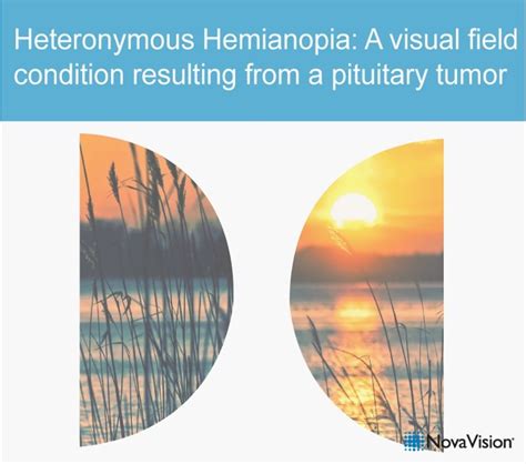 Heteronymous Hemianopia: A Visual Field Condition Resulting From A ...